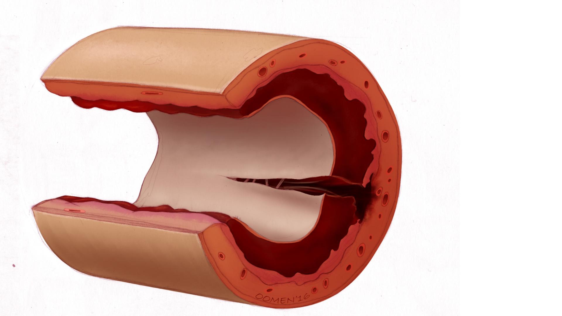 coronary dissection